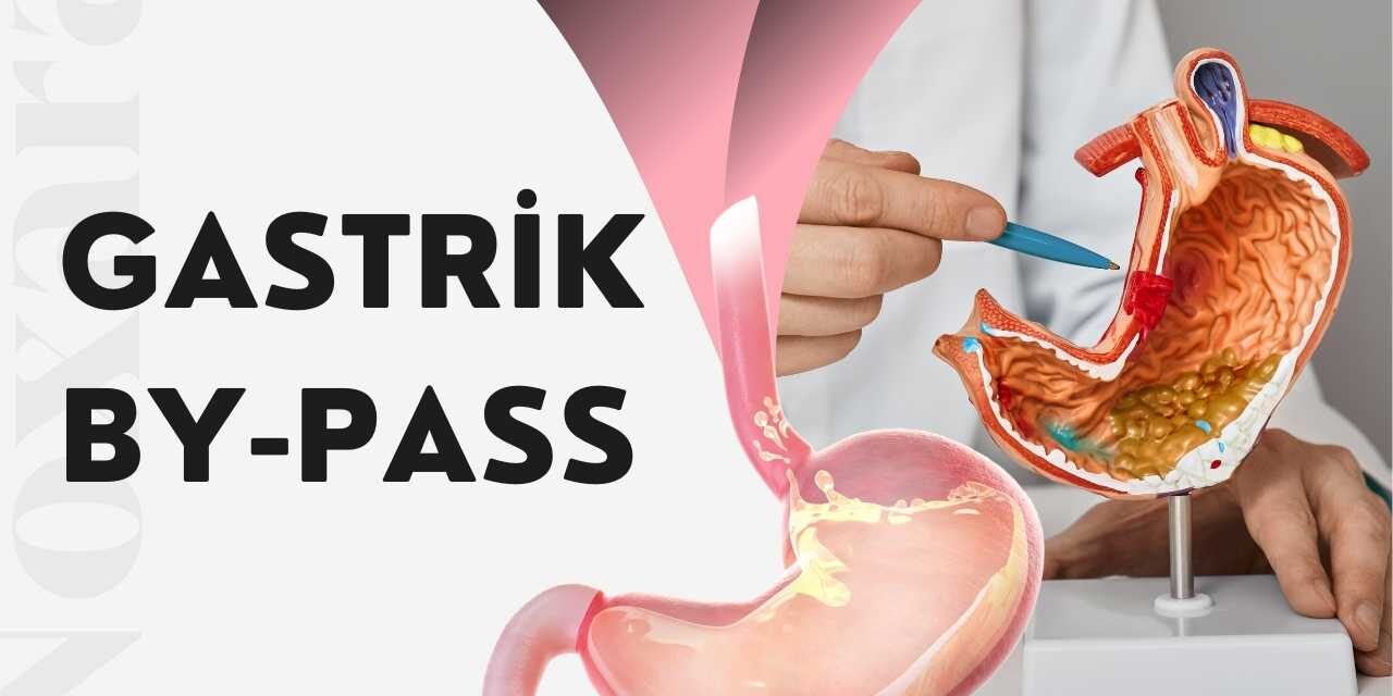 Gastrik By-pass