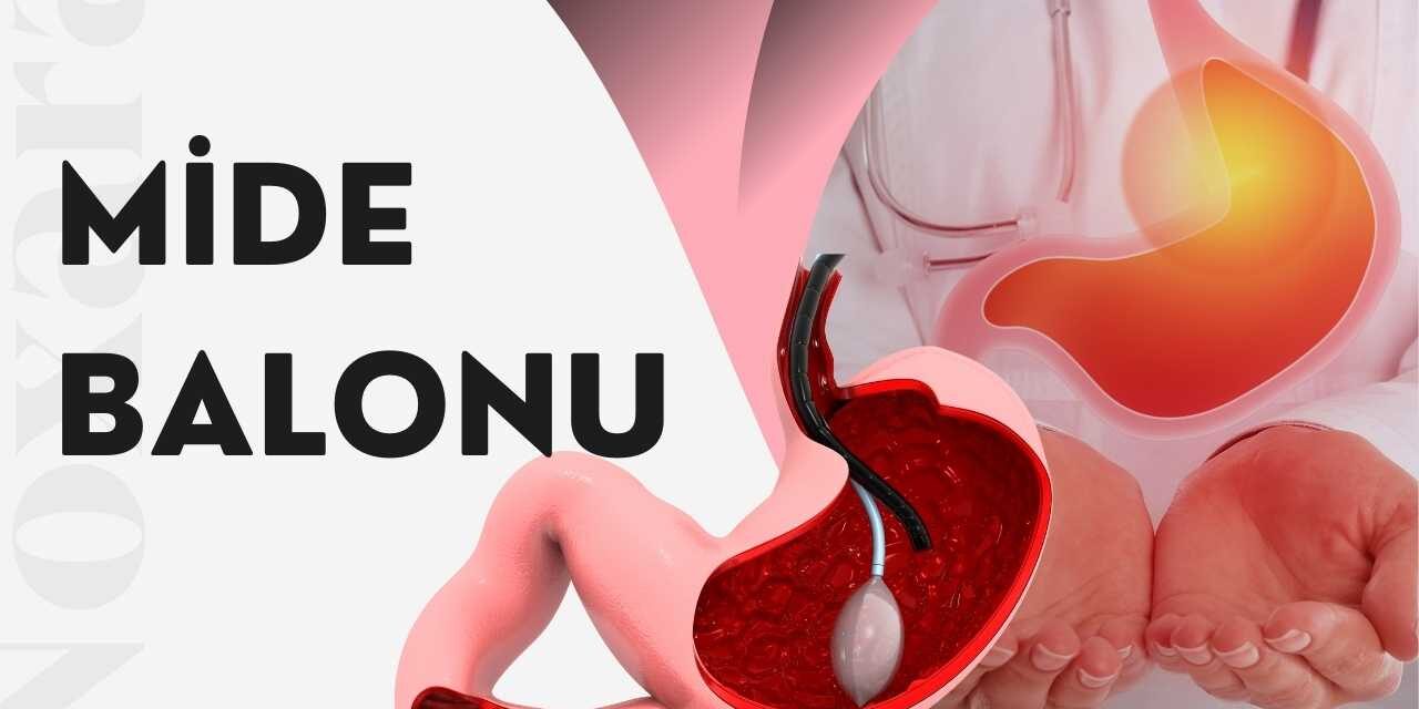 Mide Balonu