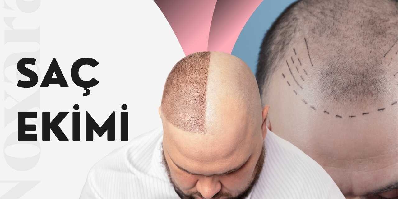 Saç ekimi