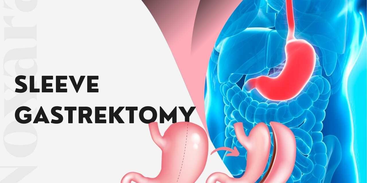 Sleeve Gastrektomy